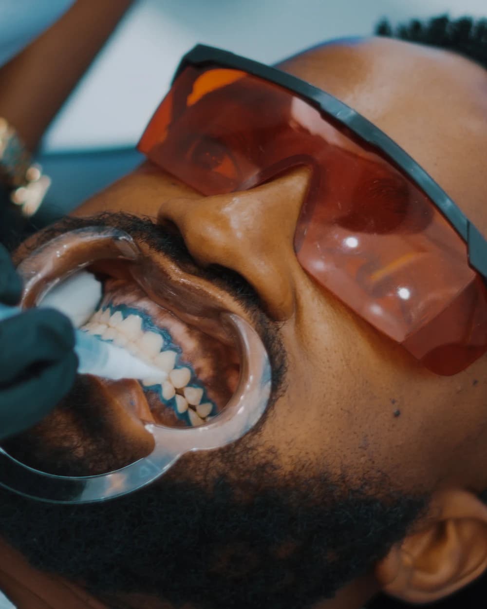 A patient receiving a professional teeth-whitening treatment