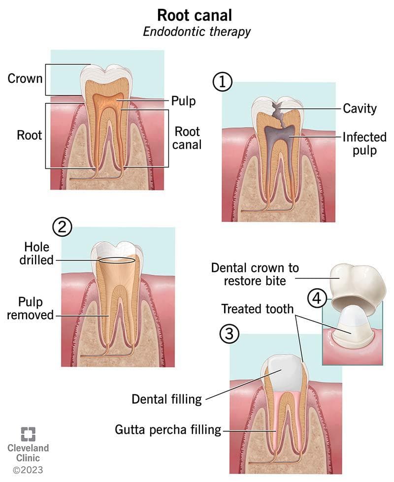 Root canal and dental crown treatment diagram
