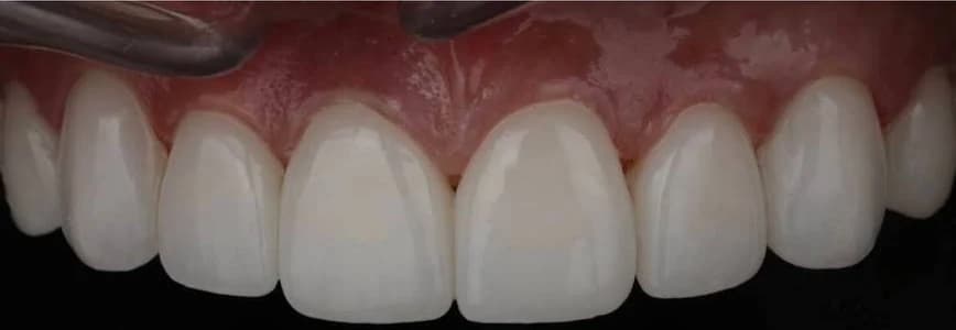 Close-up of the porcelain veneers Vivi received