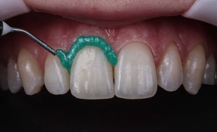 Teeth Whitening in Korea: Realistic Results & Pricing
