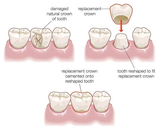Close-up of dental crown materials and tooth restoration for a Korea dental crown guide