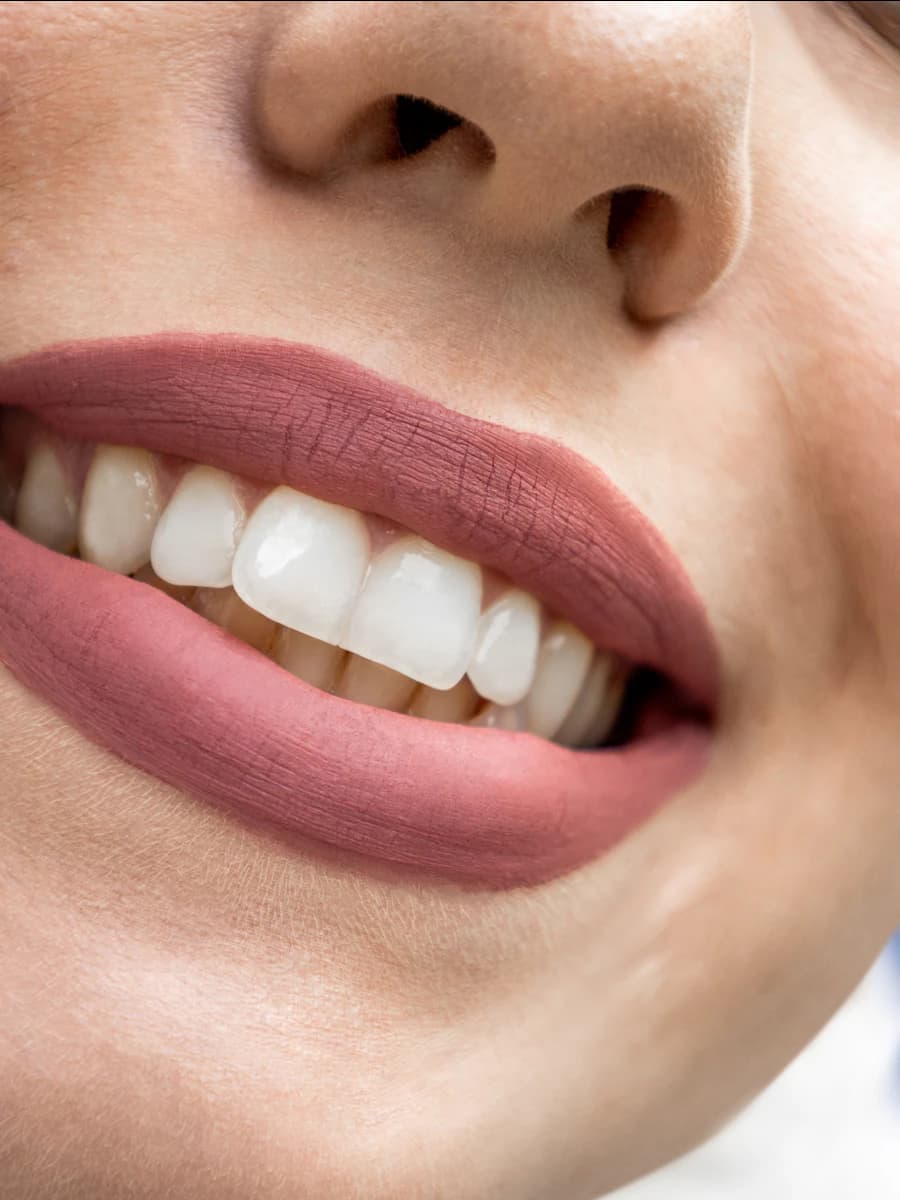 A bright, white smile after professional whitening